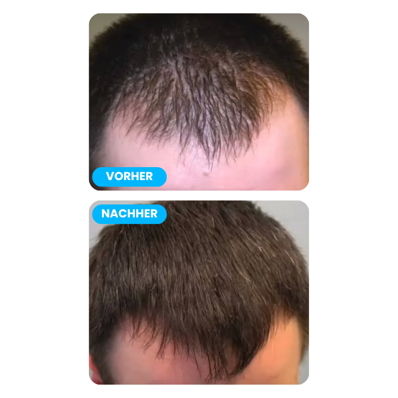 All-In-One Haarwuchsset